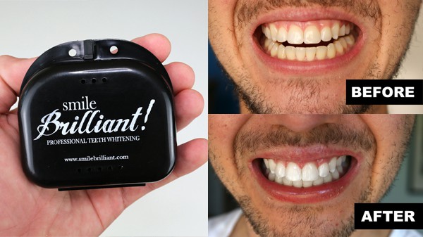 Smile Brilliant Reviews – Does it Really Work?