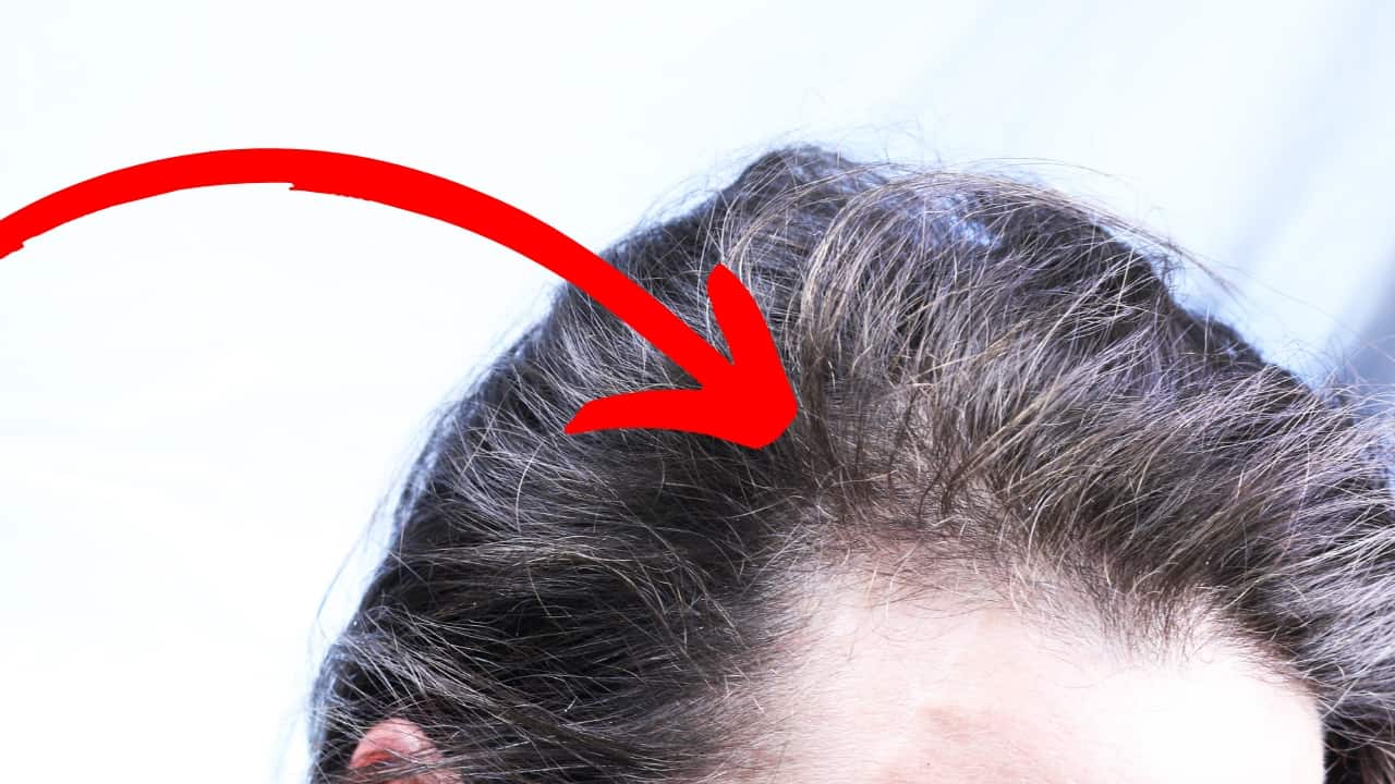 iRestore professional laser hair growth system before photos